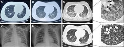 Case report: Miliary tuberculosis complicated by pediatric acute respiratory distress syndrome in a 12-year-old girl